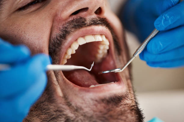 Best Emergency Wisdom Tooth Extraction in Brewster, OH